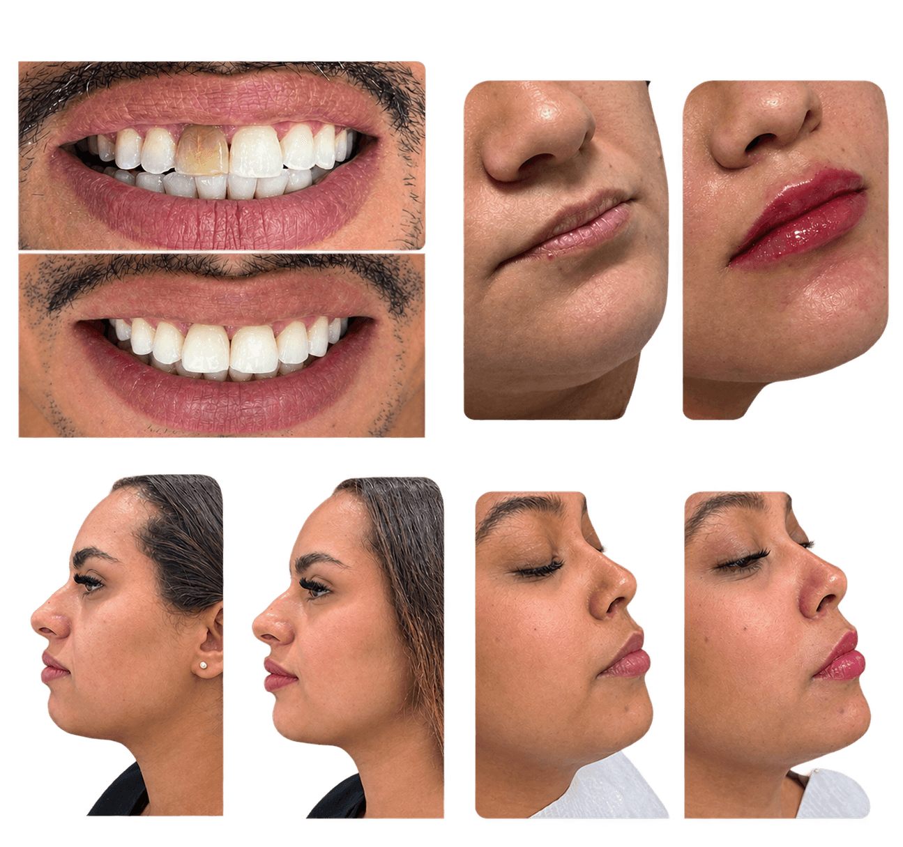 Montagem de resultados de procedimentos realizados pela equipe LB Odontologia